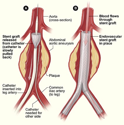 Drawing of endovascular aneurysm repair, with graft undeployed and deployed